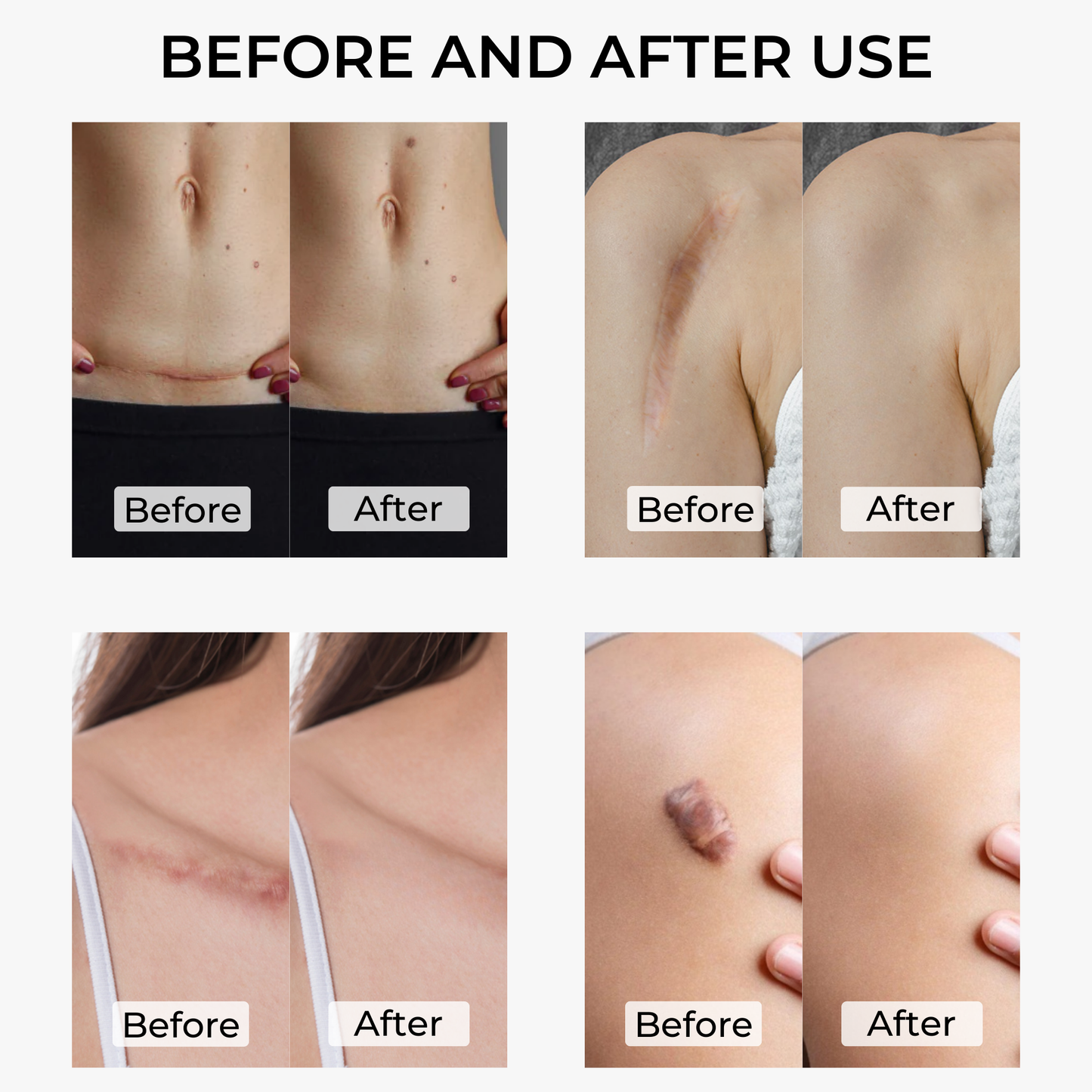 SakuraTape Scar Cover Patch 2.6cm x 7cm - conceals surgery scars, multiple skin