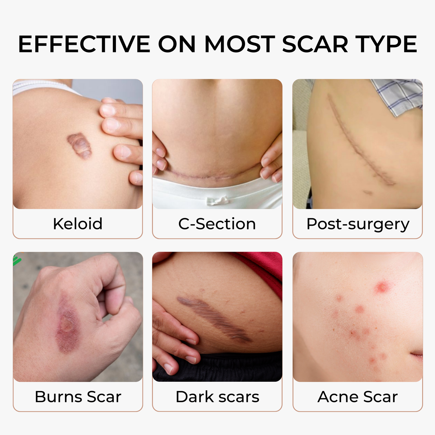 SakuraTape Scar Cover Patch 8cm x 10cm - conceals dark scars, burn scars, multiple skin