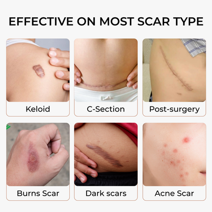 SakuraTape Scar Cover Patch 8cm x 10cm - conceals dark scars, burn scars, multiple skin